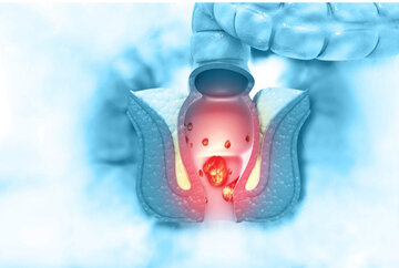 آشنایی با هموروئید و درد مقعدی ناشی از یبوست